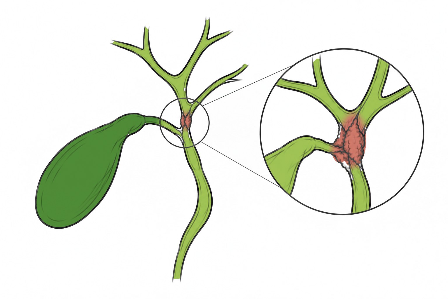 Colangiocarcinoma