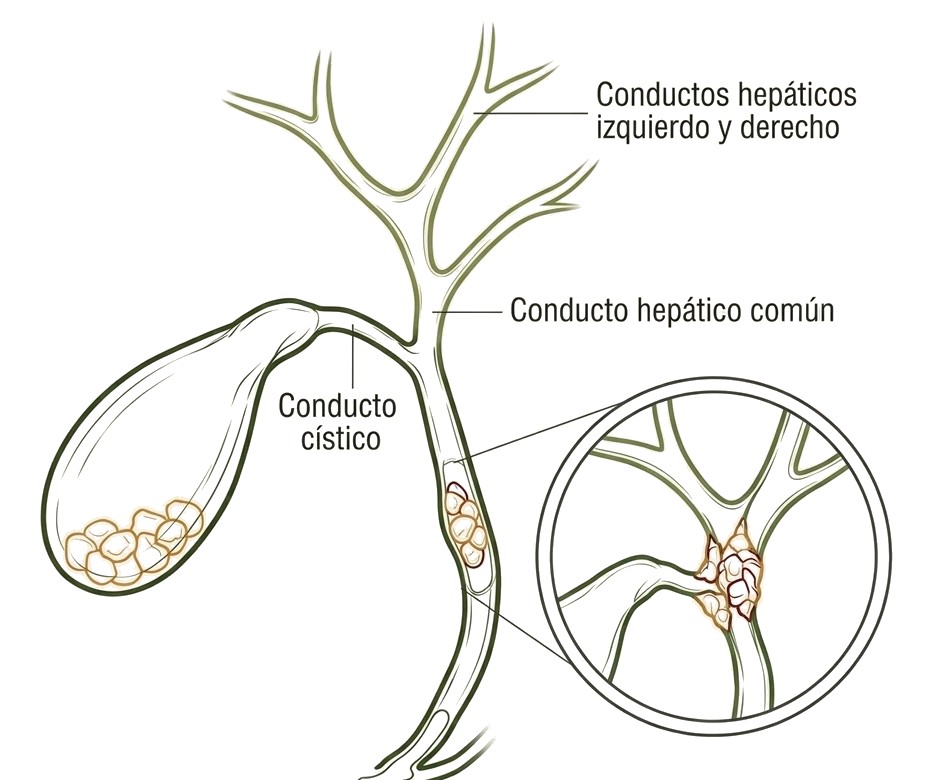 Colangiocarcinoma