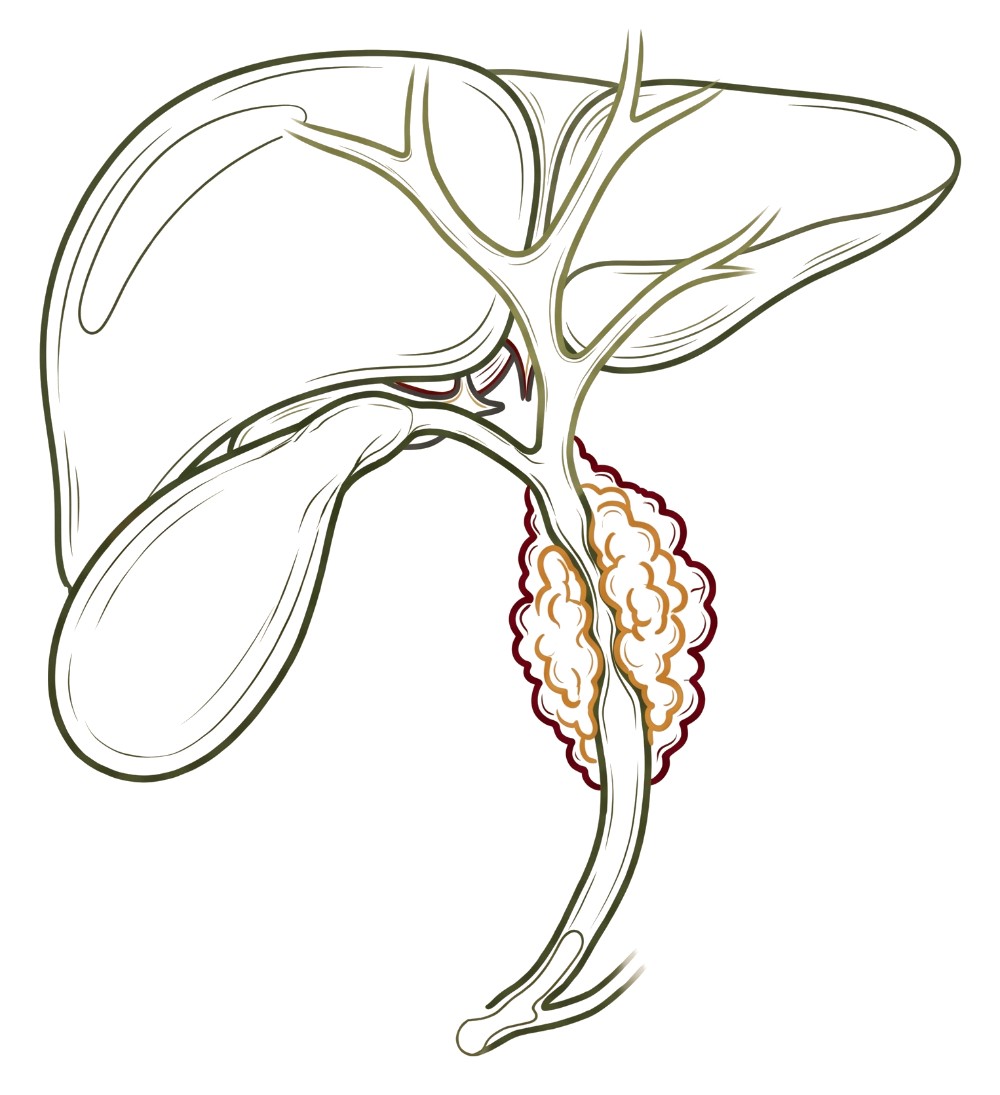 Colangiocarcinoma