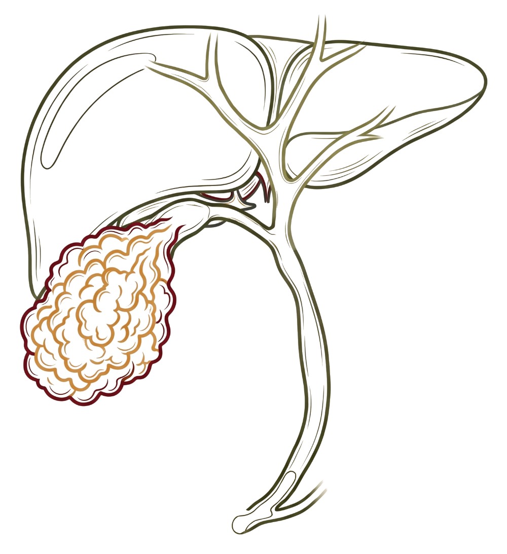 Cáncer de vesícula biliar
