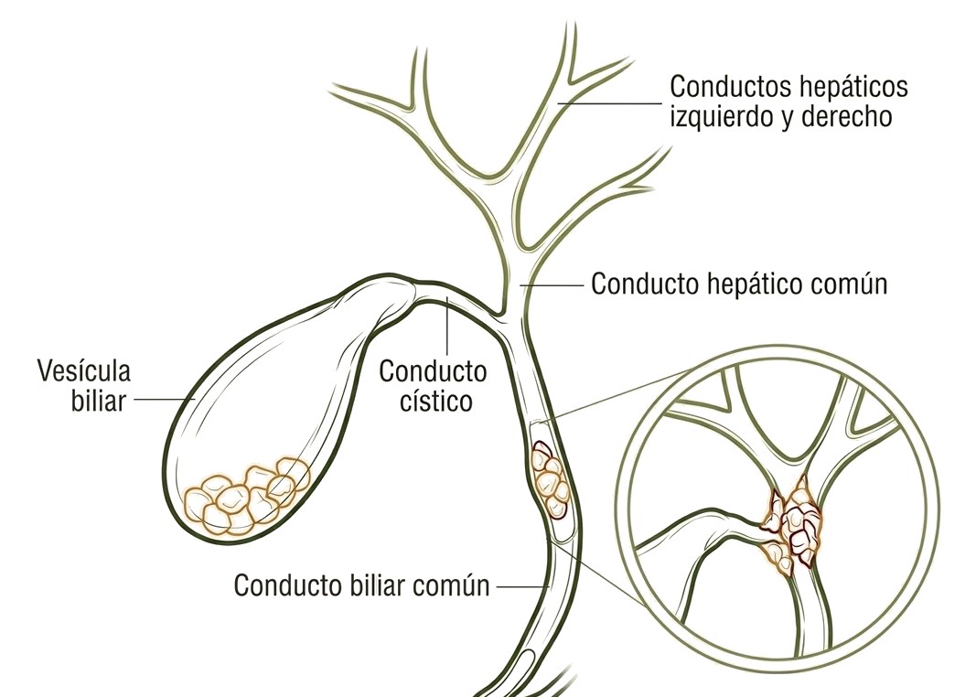 Enfermedad de vesícula y vías biliares